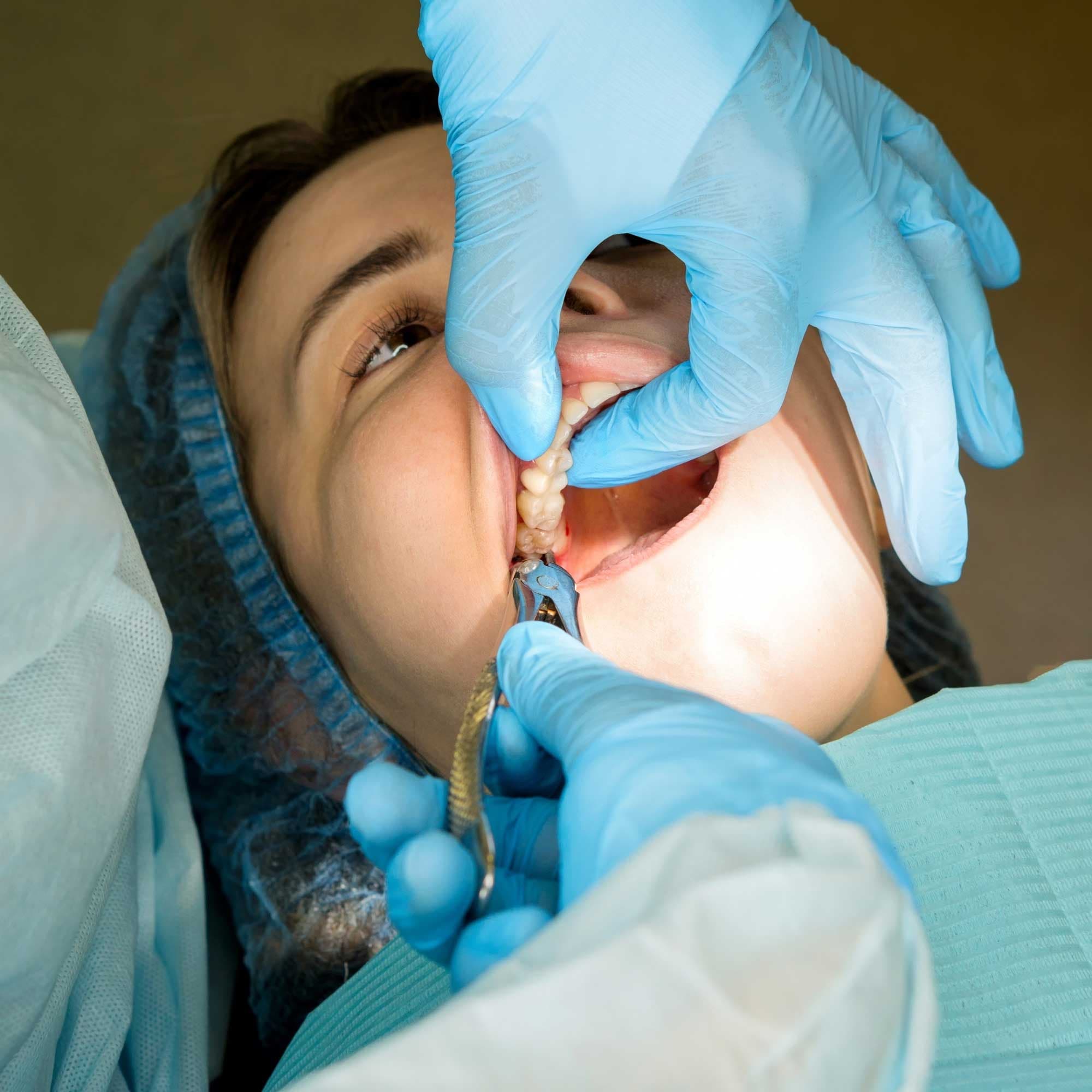 Extração de Terceiros Molares (Siso) com Planejamento Cirúrgico