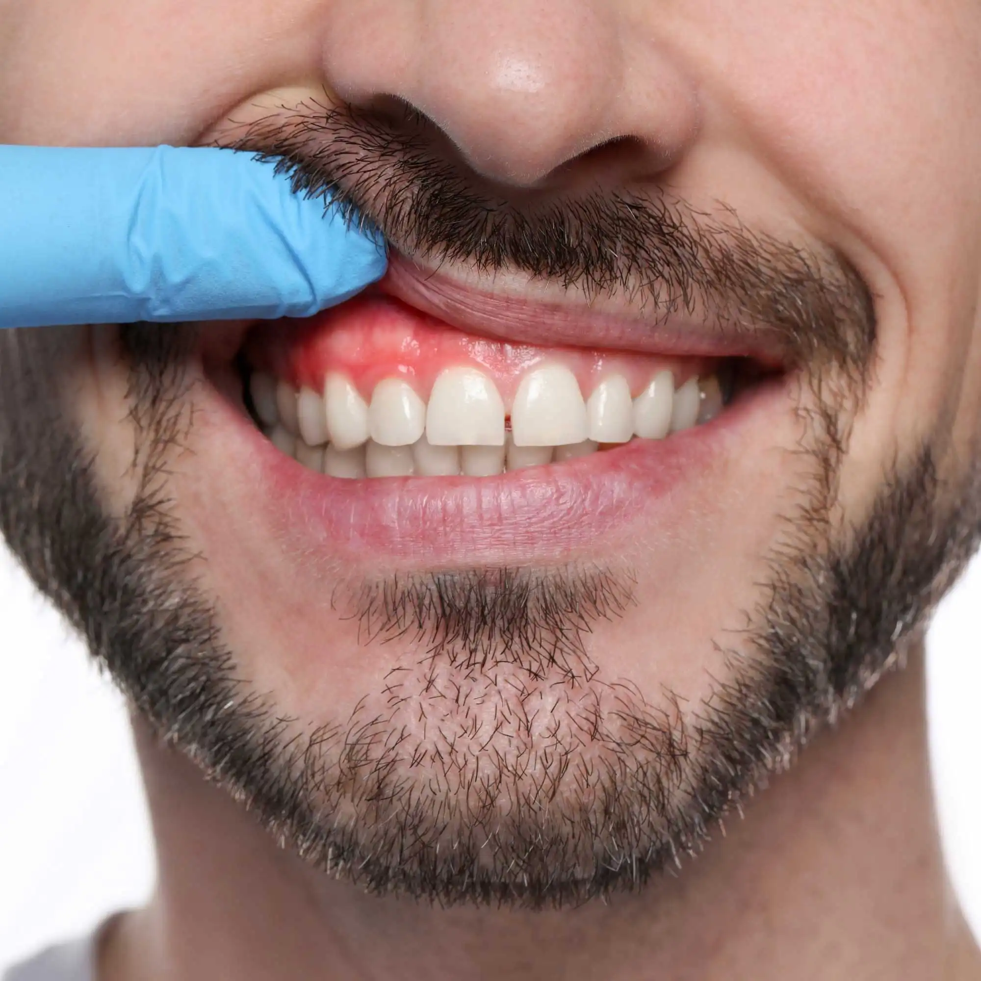 Periodontia Avançada – Tratamento da Gengiva e Tecidos Moles