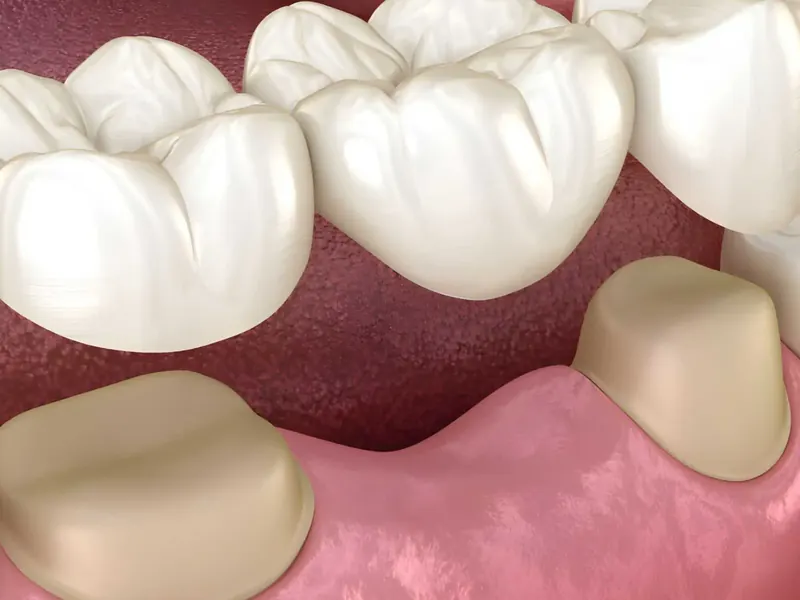 Prótese Dentária sobre Dentes Naturais