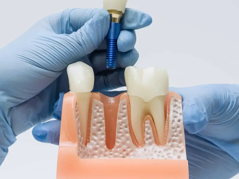 Prótese Dentária sobre Implantes