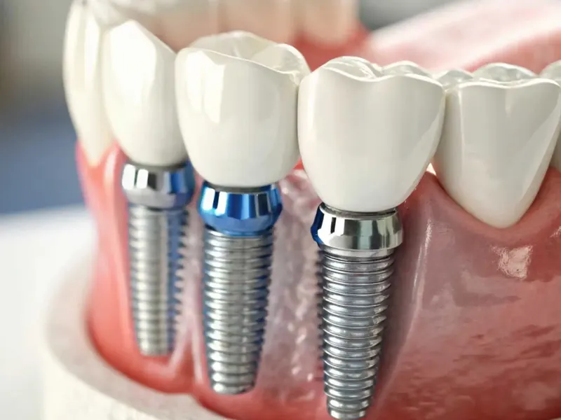 Reabilitação Oral Completa com Implantes