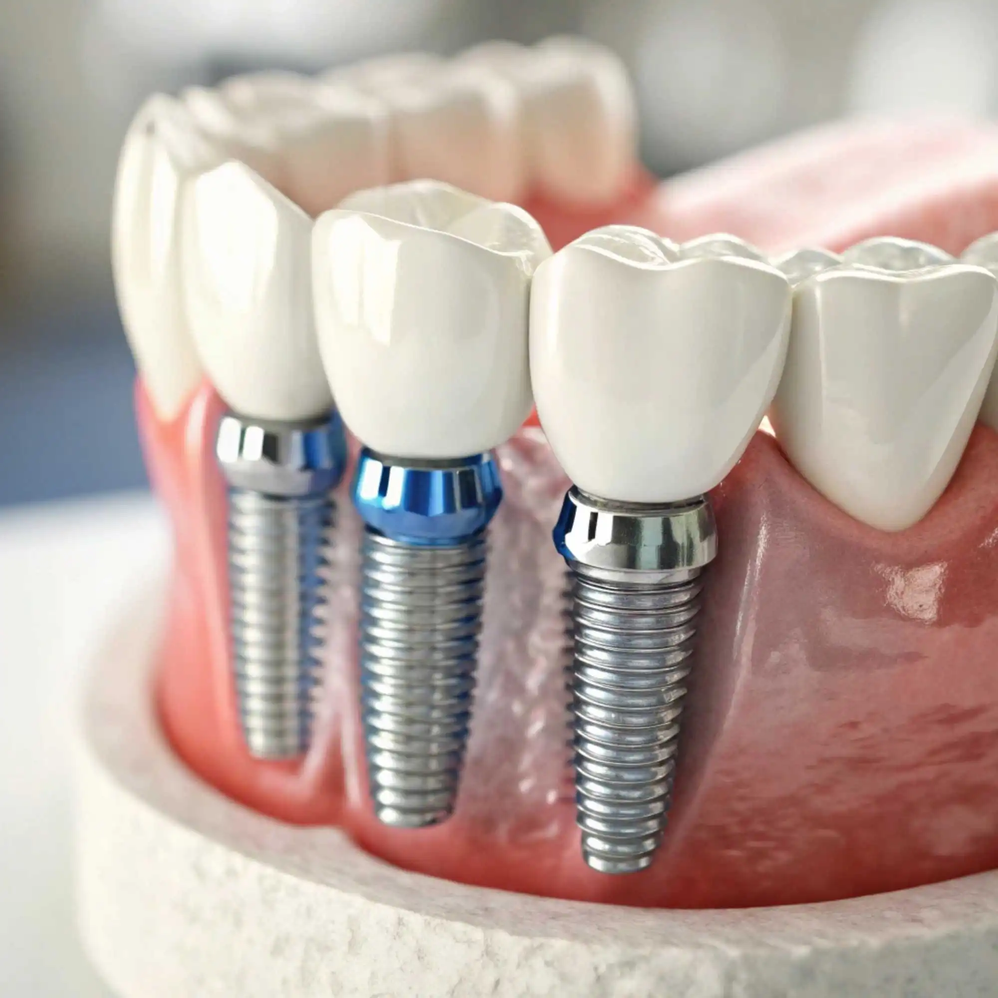 Reabilitação Oral Completa com Implantes