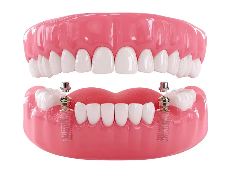 Reabilitação Oral Mista com Implantes e Próteses sobre Dentes Naturais