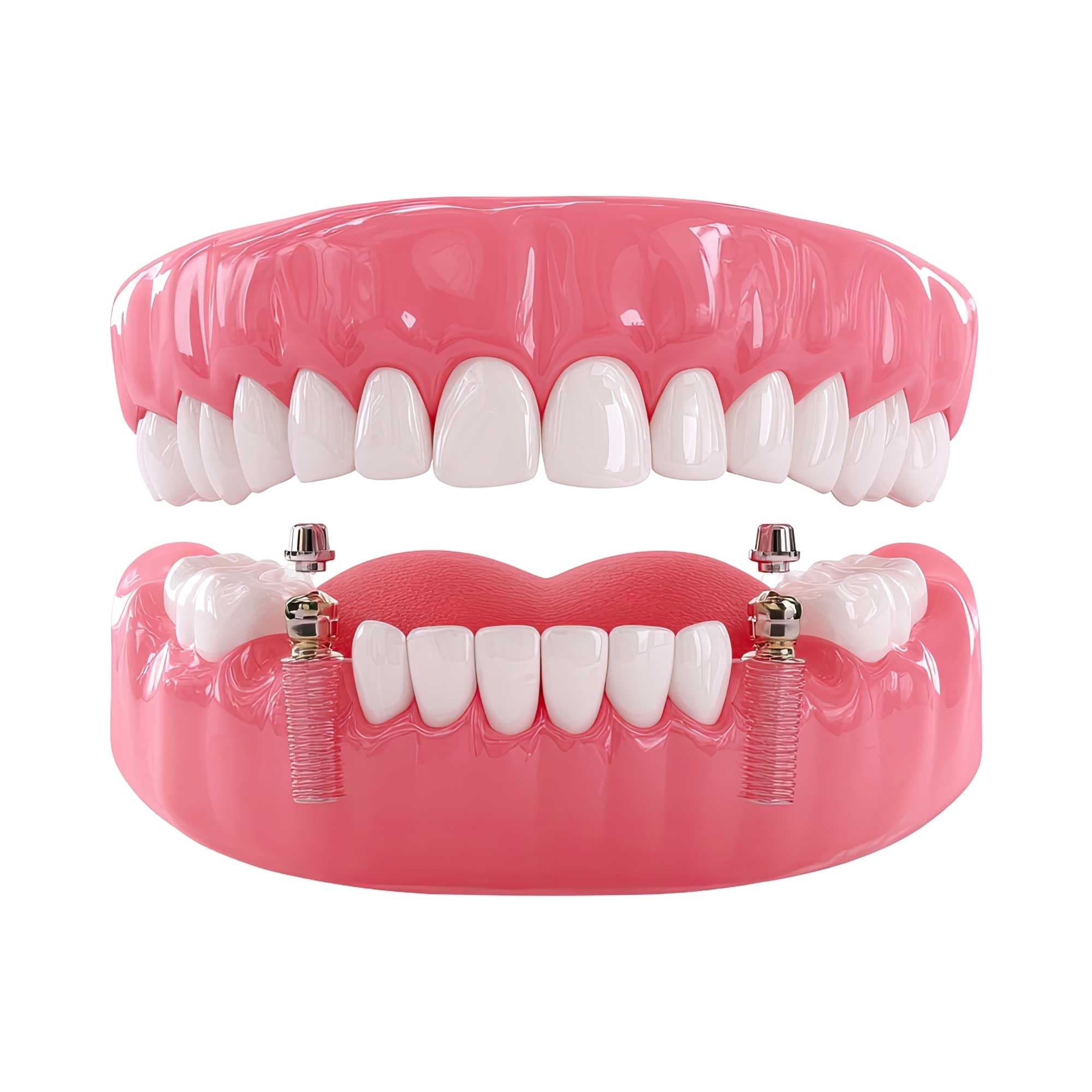 Reabilitação Oral Mista com Implantes e Próteses sobre Dentes Naturais